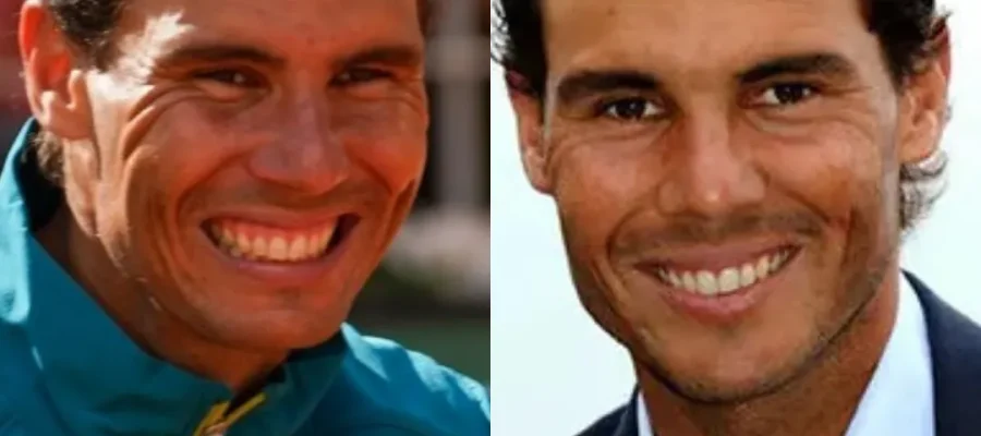 Rafael Nadal Hair Transplant