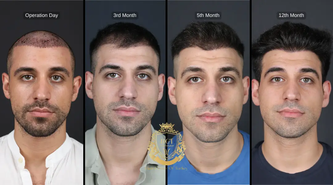 Recovery Process After Sapphire FUE Hair Transplant