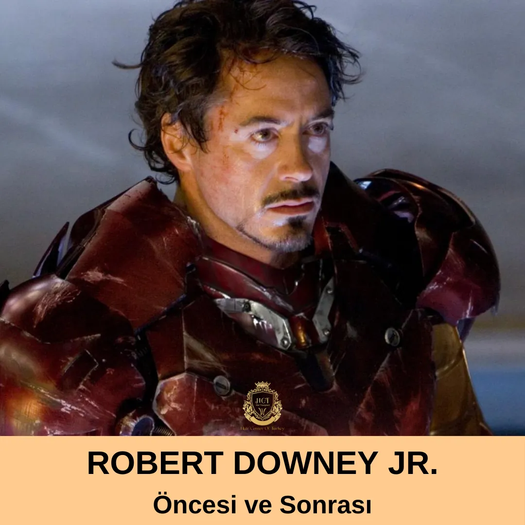 Robert Downey Jr. Hair Transplant|Robert Downey Jr. Saç Ekimi fi