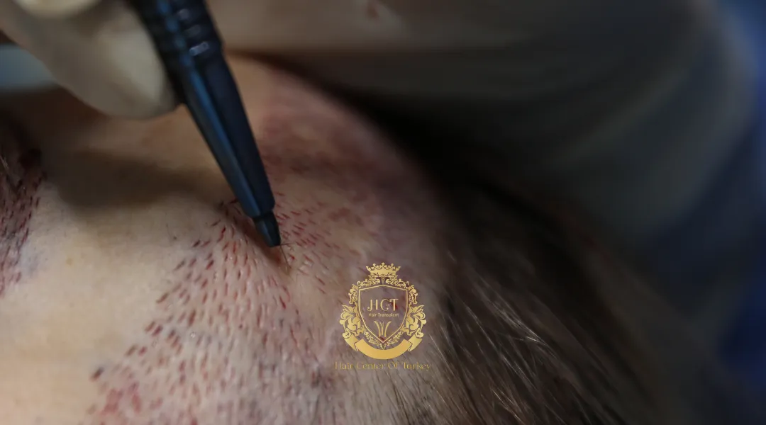 Saffier FUE-haartransplantatie