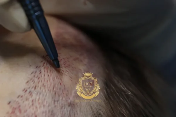 Sapphire FUE Hair Transplant