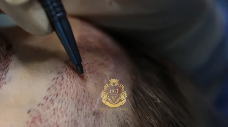 Sapphire FUE Hair Transplant Turkey