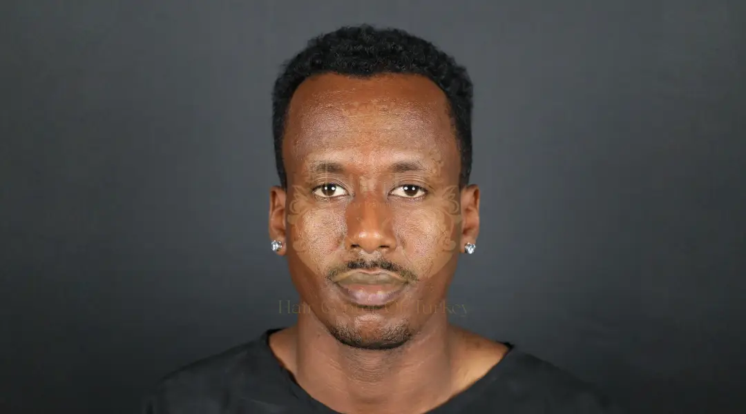 Trasplante Capilar Afro en Turquía