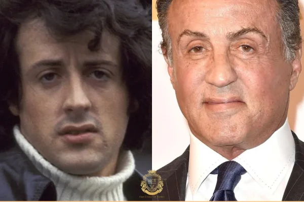 Sylvester Stallone Haartransplantation