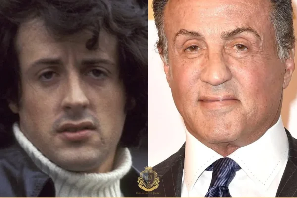 Sylvester Stallone Haartransplantatie