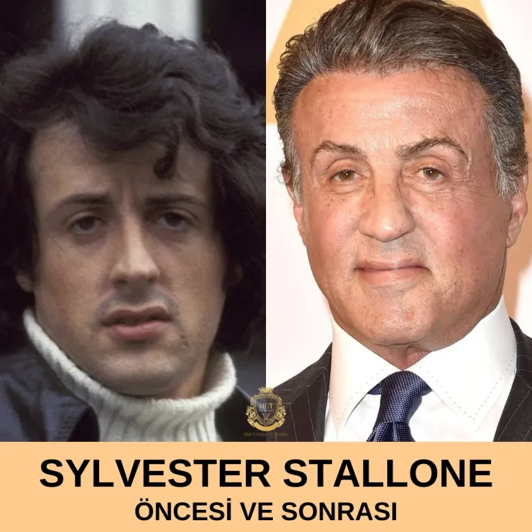 Sylvester Stallone Hair Transplant Before and After|Sylvester Stallone Saç Ekimi Öncesi ve Sonrası