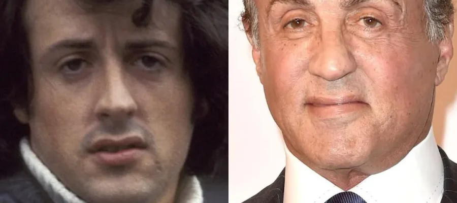 Sylvester Stallone Hair Transplant Before and After|Sylvester Stallone Saç Ekimi Öncesi ve Sonrası