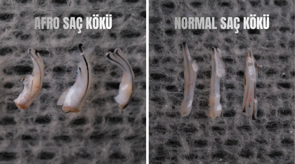 Afro Saç Ekimi 4 Afro Saç Ekimi