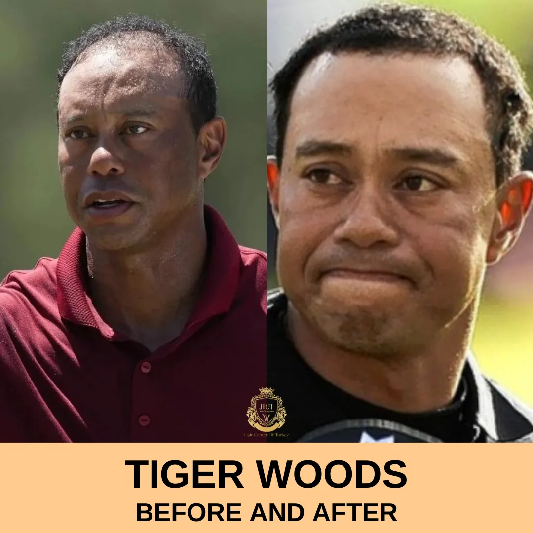 Tiger Woods Haartransplantatie 1 Tiger Woods Hair Transplant