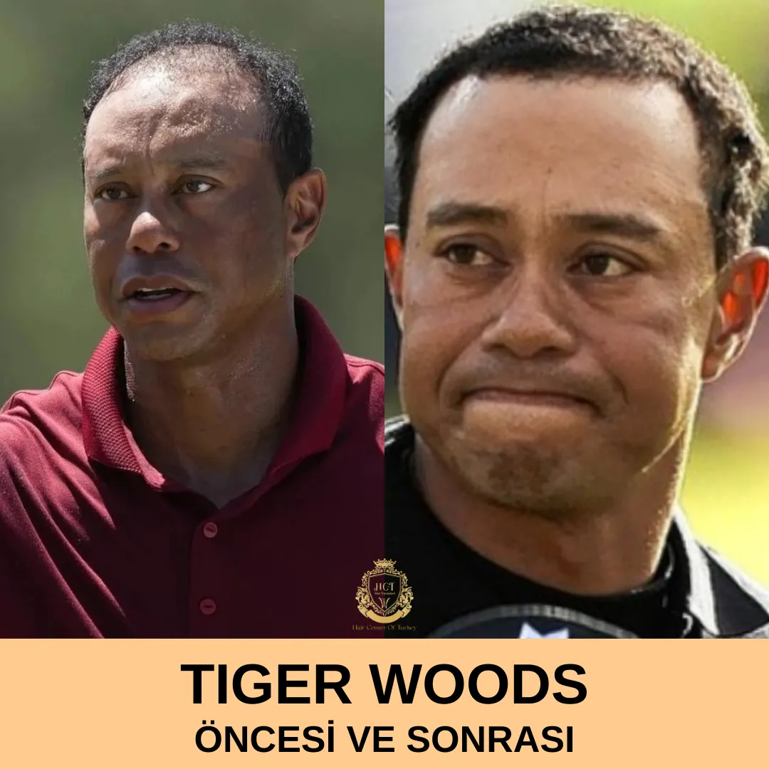 Tiger Woods Hair Transplant|Tiger Woods Saç Ekimi