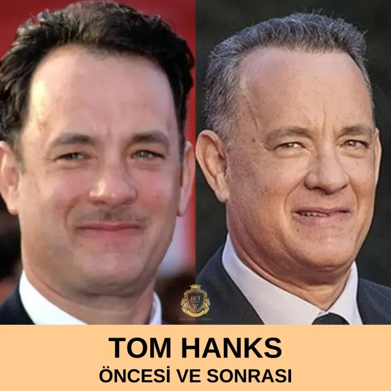 Tom Hanks Hair Transplant|Tom Hanks Saç Ekimi
