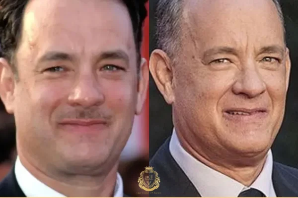 Tom Hanks Haartransplantation