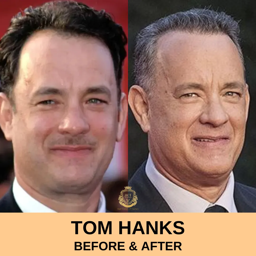 Tom Hanks Haartransplantation 1 Tom Hanks Hair Transplant