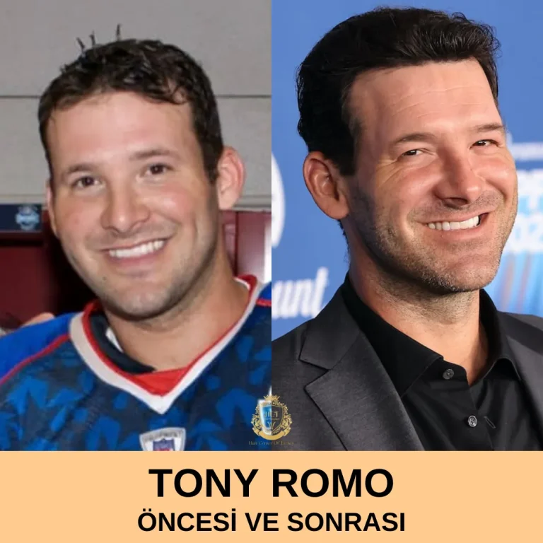 Tony Romo Hair Transplant|Tony Romo Saç Ekimi