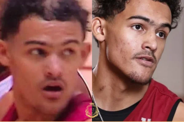 Trae Young Haartransplantation
