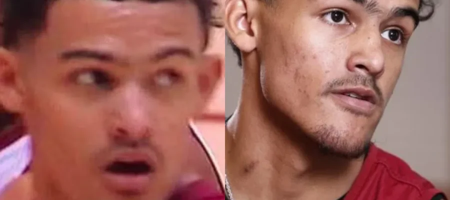 Trae Young Haartransplantation 1 Trae Young Hair Transplant