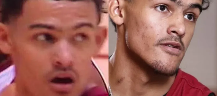 Trae Young Saç Ekimi 1 Trae Young Hair Transplant |Trae Young Saç Ekimi