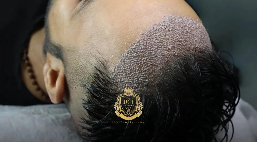 Greffe de cheveux sans rasage 1 Greffe de cheveux non rasés