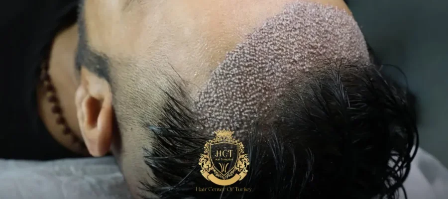 Unrasierte Haartransplantation
