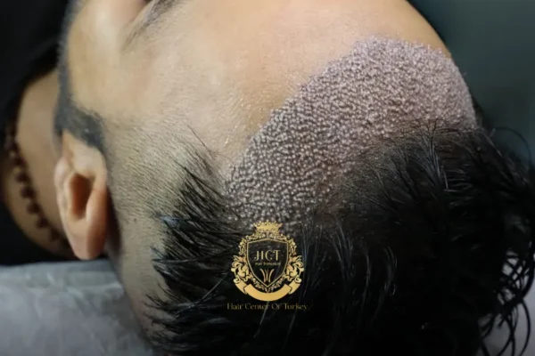 Unshaven Hair Transplant