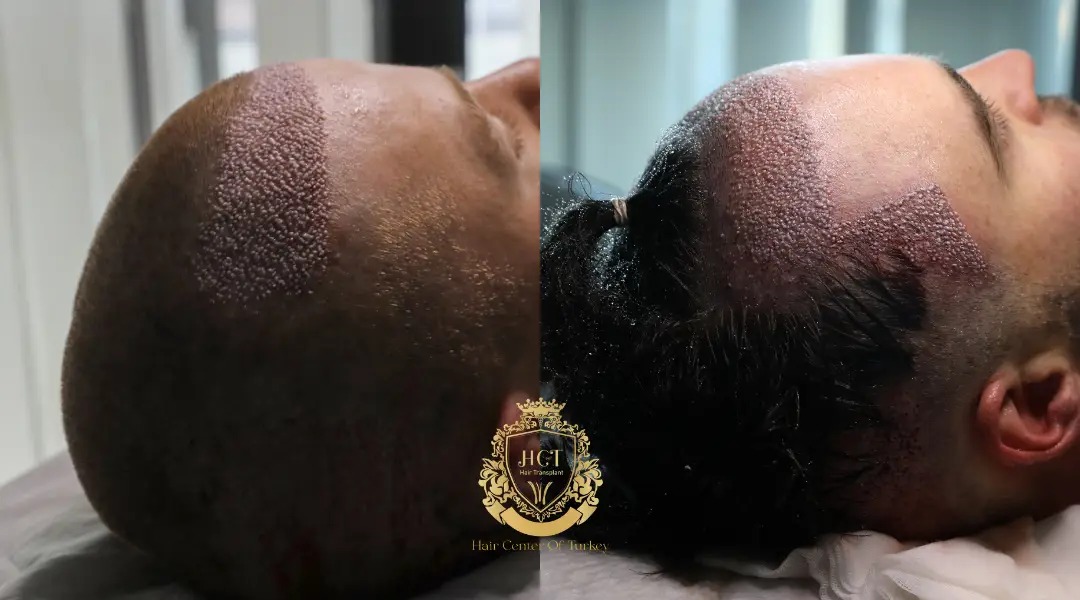 Unshaven Vs Shaven Hair Transplant