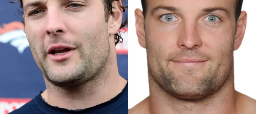 Wes Welker Hair Transplant |Wes Welker Saç Ekimi