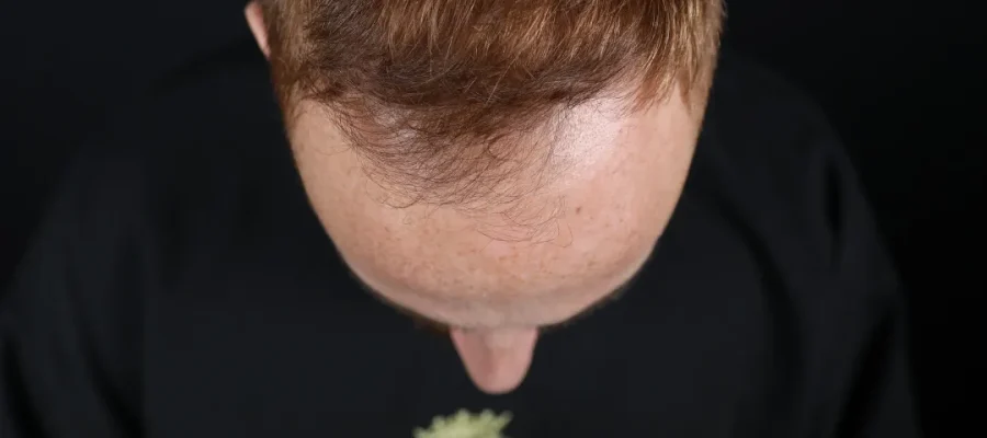 What Age Does Male Pattern Baldness