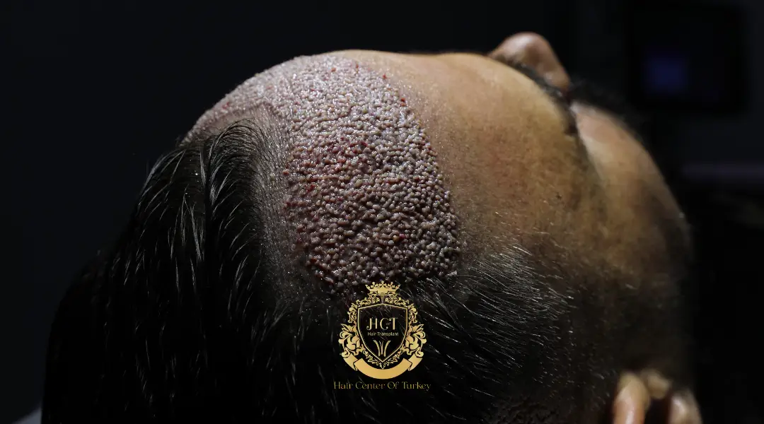 What Is An Unshaven Hair Transplant