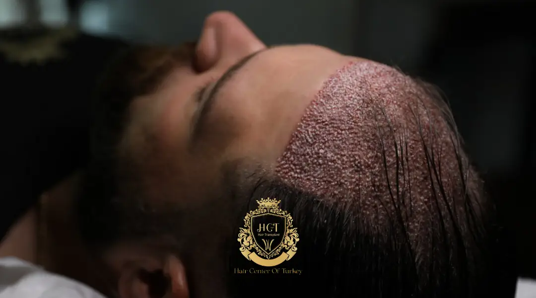 What To Expect After A DHI Hair Transplant