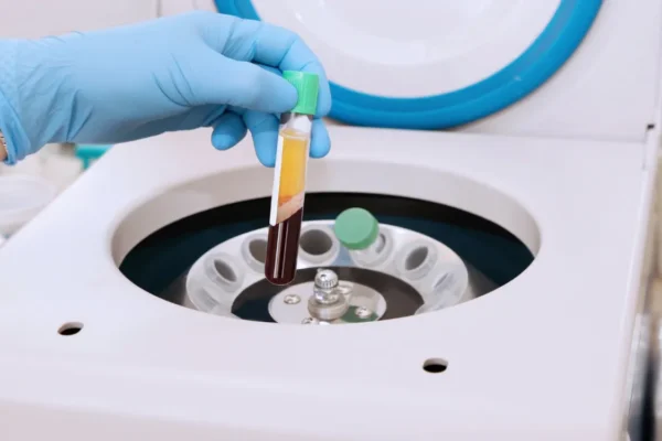 PRP (Platelet-Rich Plasma) for Hair Treatment