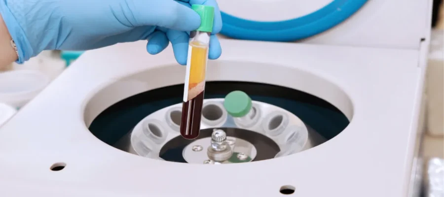 PRP (plättchenreiches Plasma) zur Haarbehandlung