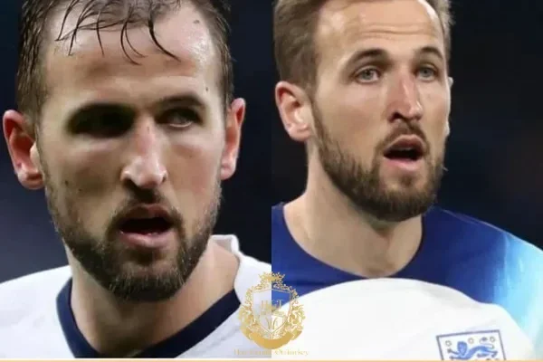 Harry Kane Haartransplantatie