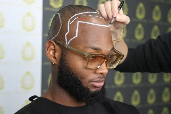 Afro Hair Transplant Turkey