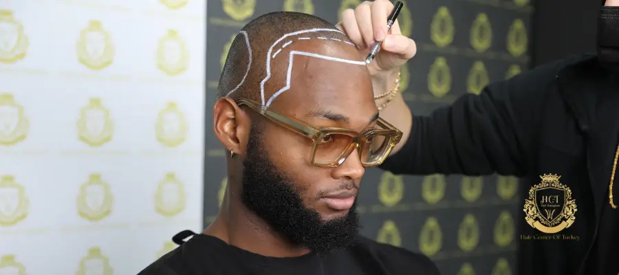 Afro Saç Ekimi 1 afro hair transplant turkey