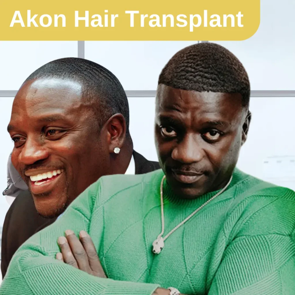 Le Parcours D'akon Vers La Greffe De Cheveux : Ce Qu'il a Partagé Sur La Turquie, Le Coût Et Les Résultats