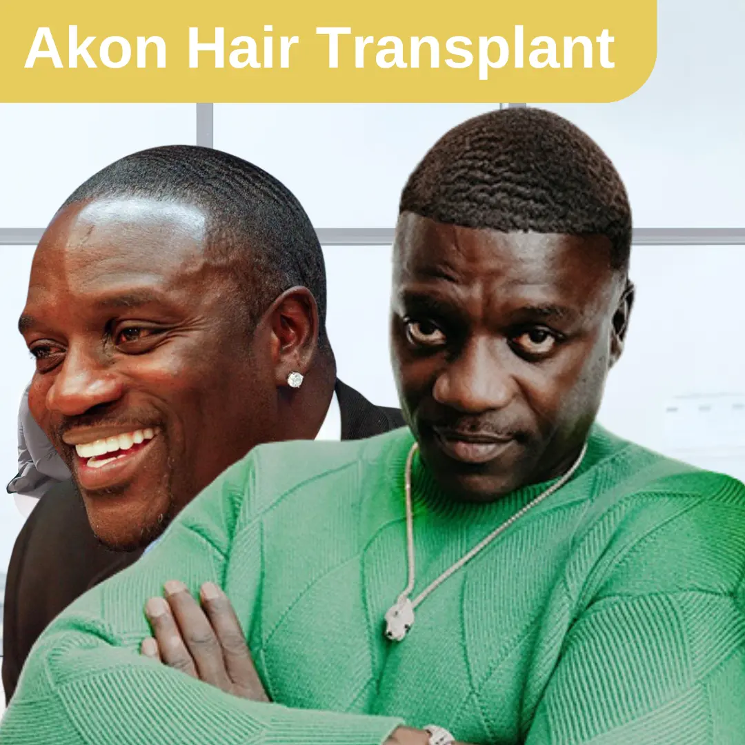 Akon’s Hair Transplant Journey: What He Shared About Turkey, Cost, and Results 1 Akon’s Hair Transplant Journey: What He Shared About Turkey, Cost, and Results