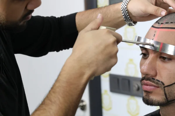 Beard Transplant Turkey