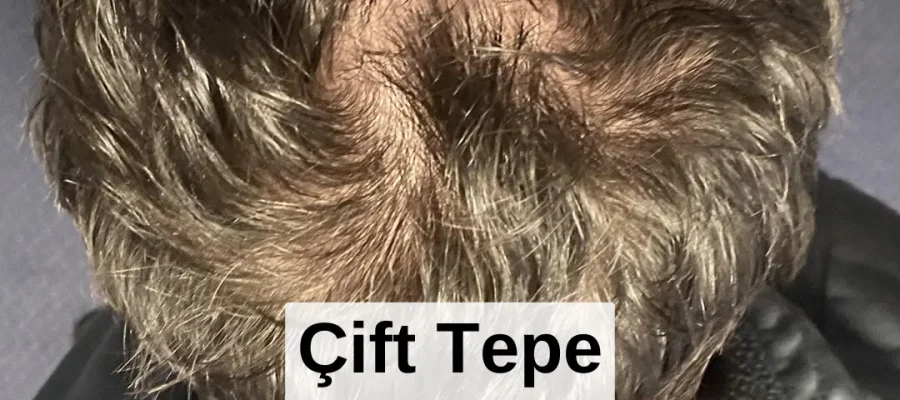 cift tepe bolgesi nedir