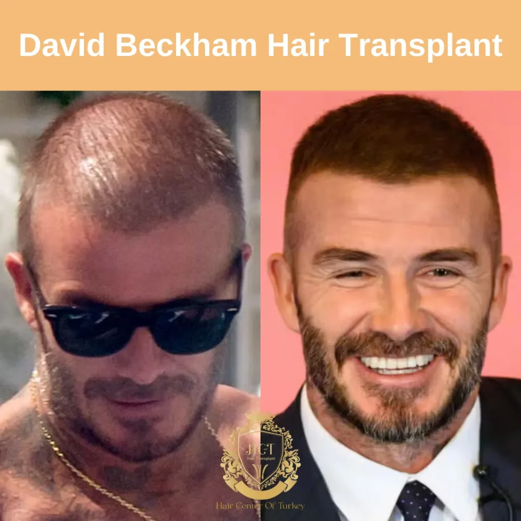 Greffe De Cheveux De David Beckham : Rumeurs, Perte De Cheveux Et Ce Que Suggèrent Les Résultats
