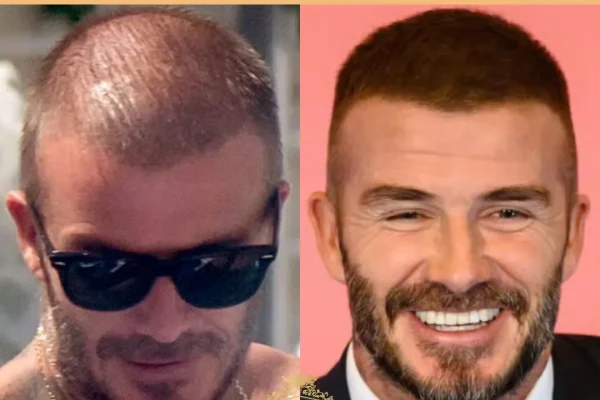 David Beckhams Haartransplantation: Gerüchte, Haarausfall Und Was Die Ergebnisse Vermuten Lassen