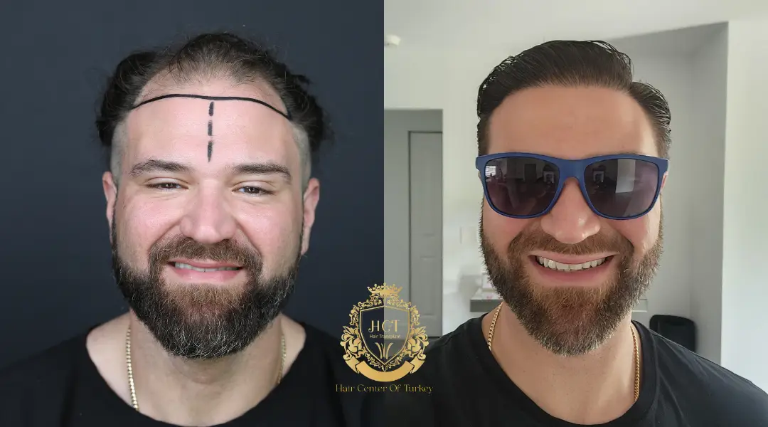 dhi before and after hair transplant