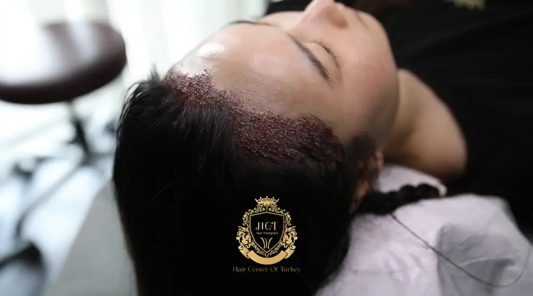 fue women hair transplant