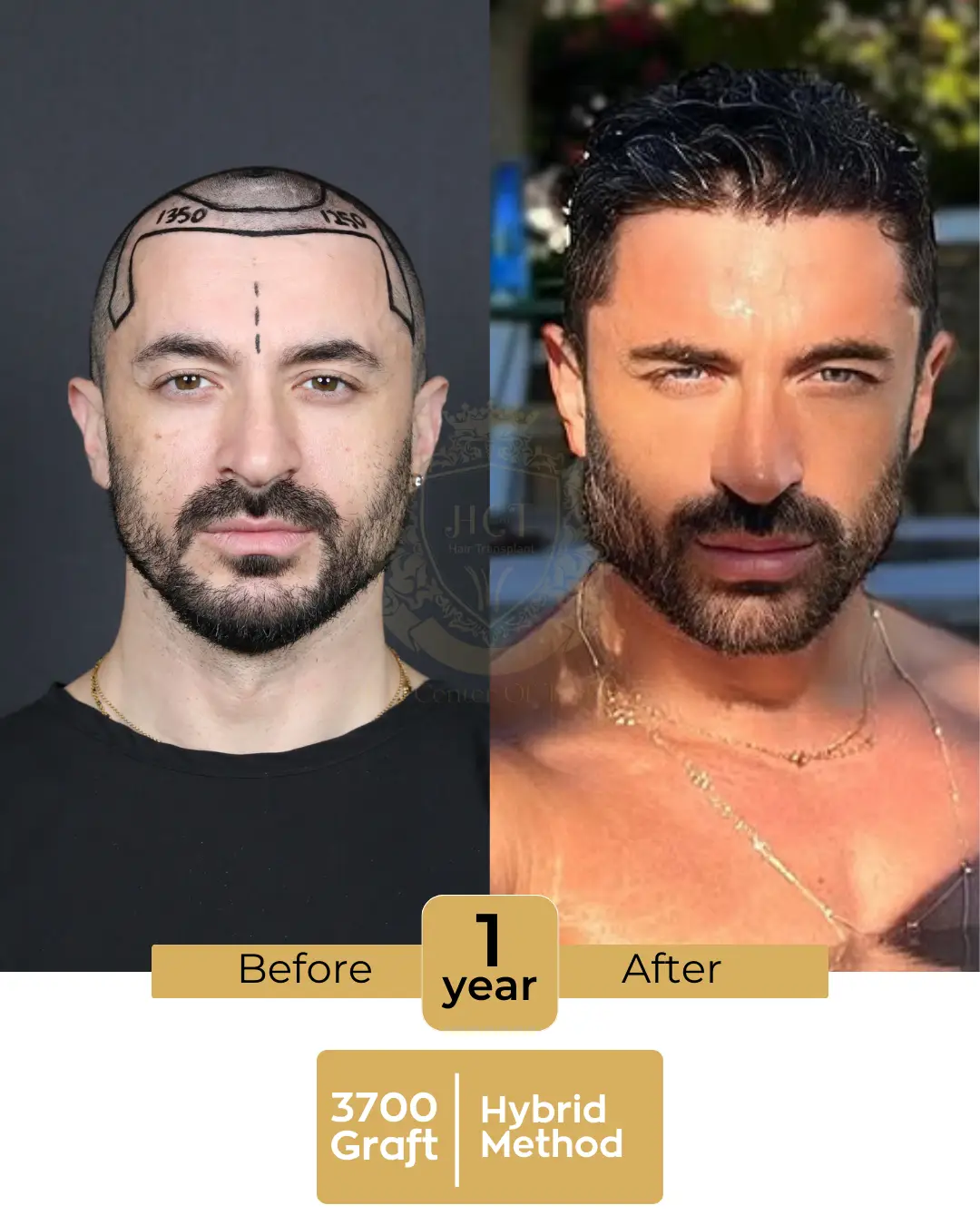 haircenterofturkey-hair-transplant-before-and-after-results-2026-01