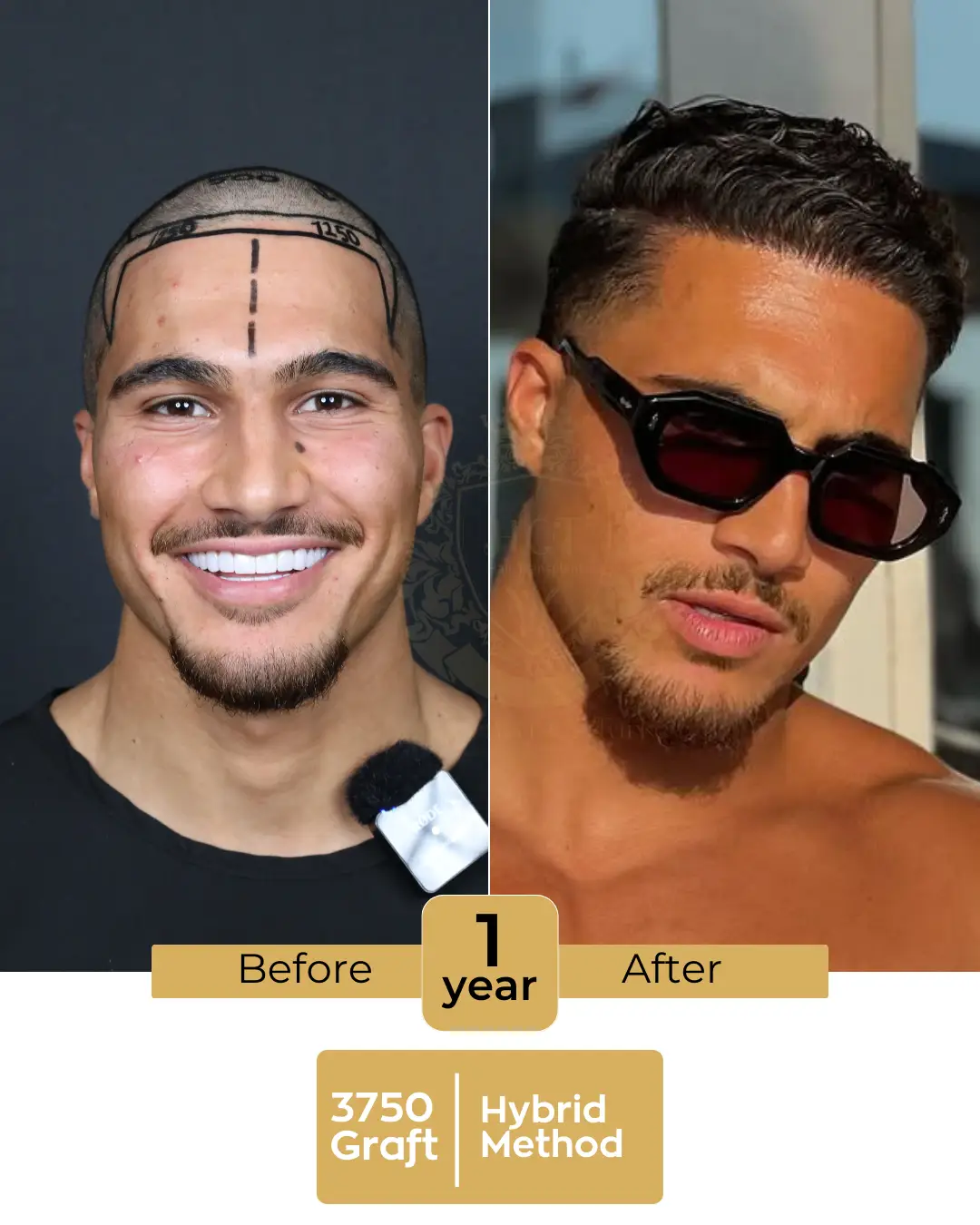 hair transplant before and after images