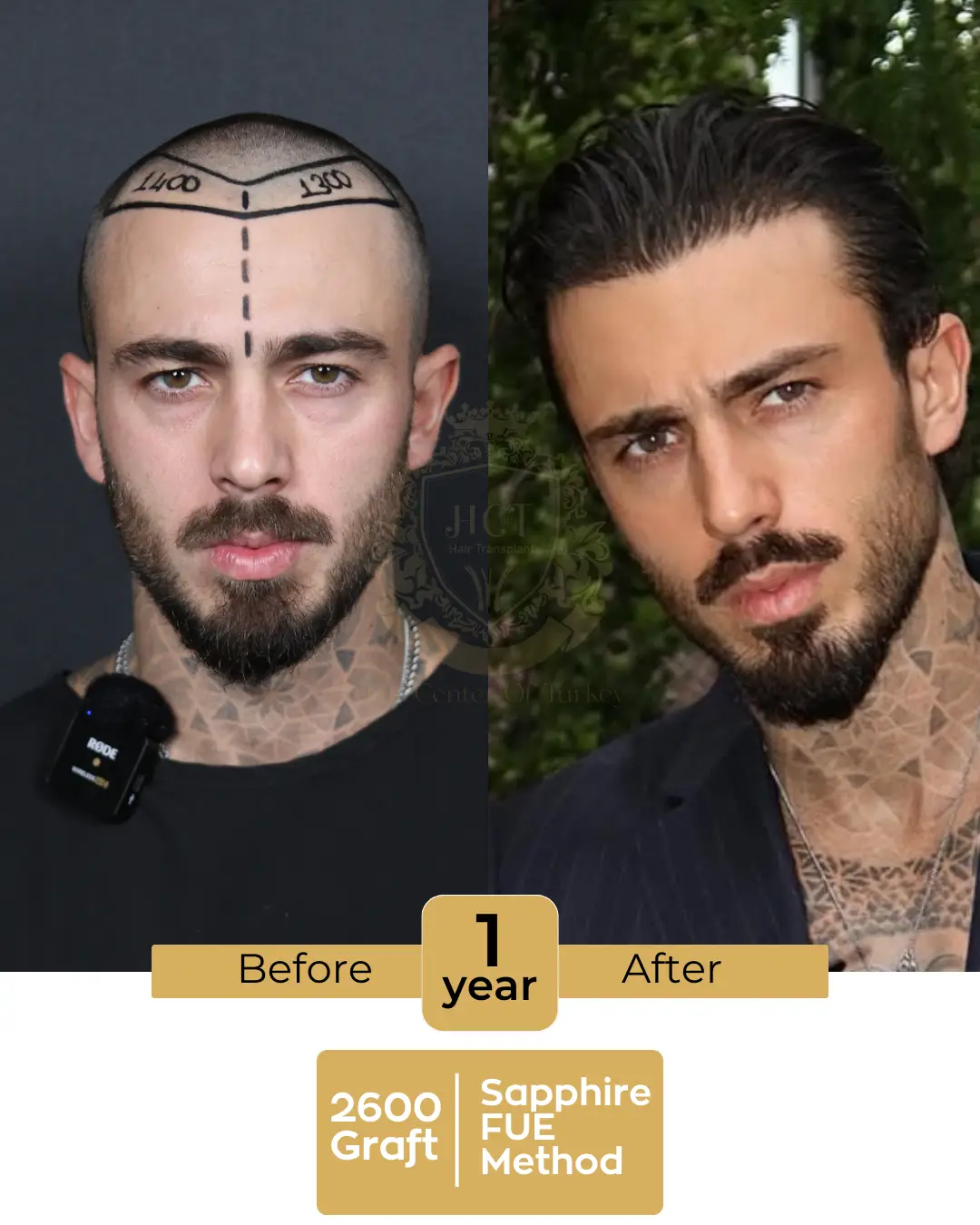 haircenterofturkey-hair-transplant-before-and-after-results-2026-03