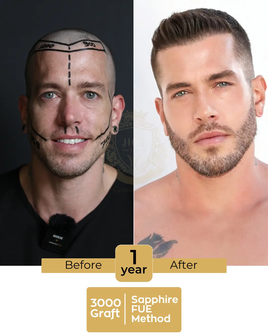 haircenterofturkey-hair-transplant-before-and-after-results-2026-04