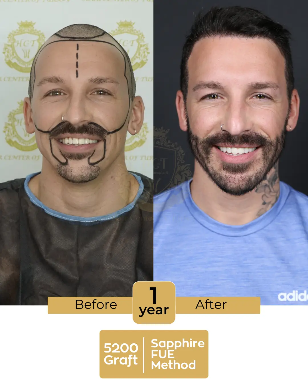 haircenterofturkey-hair-transplant-before-and-after-results-2026-05