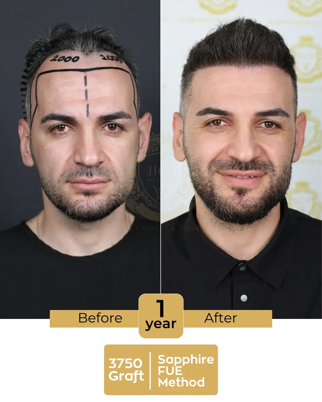 hair transplant before and after images