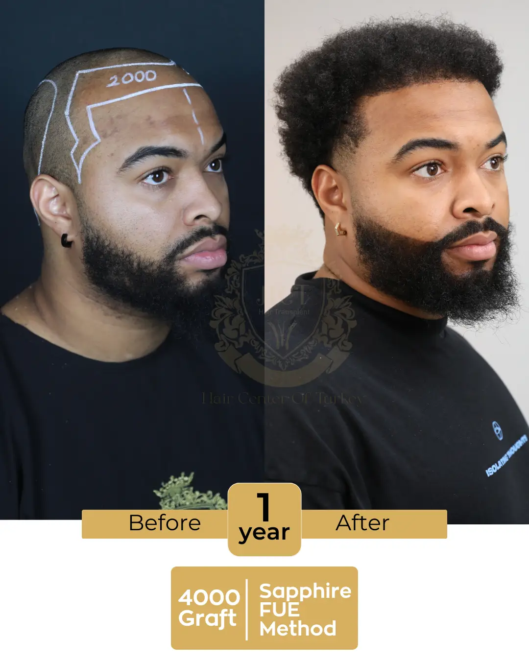 haircenterofturkey-hair-transplant-before-and-after-results-2026-07