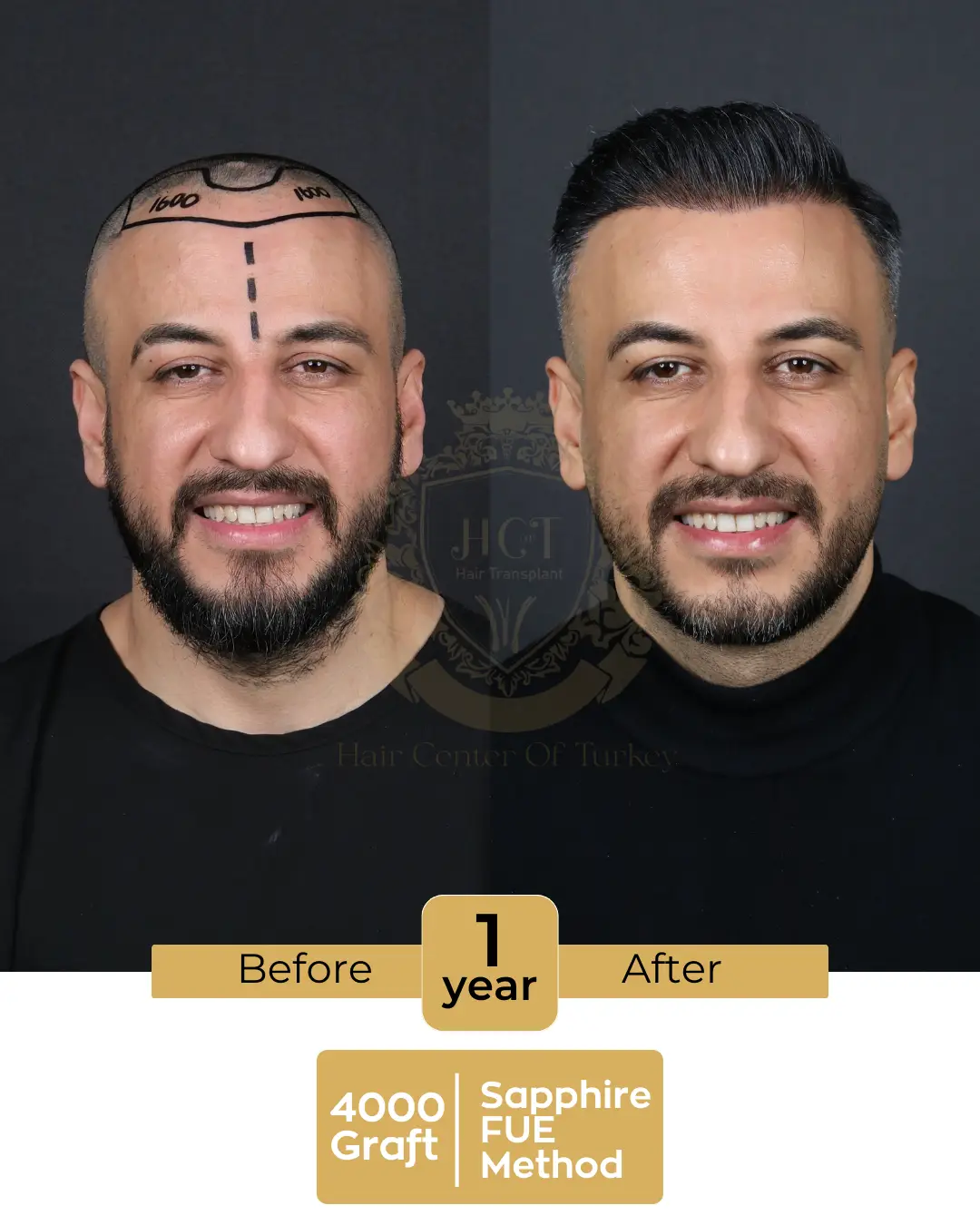 hair transplant before and after images